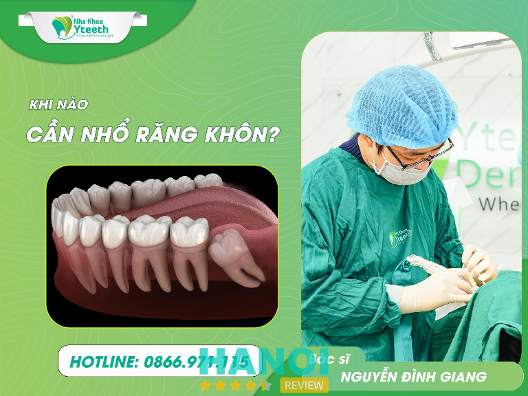 Địa chỉ nhổ răng khôn tại Hà Nội