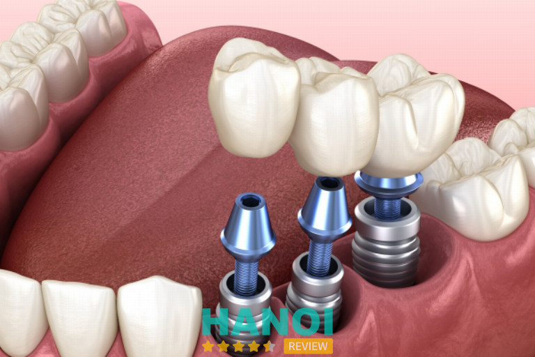 Địa chỉ trồng răng Implant tại Hà Nội 