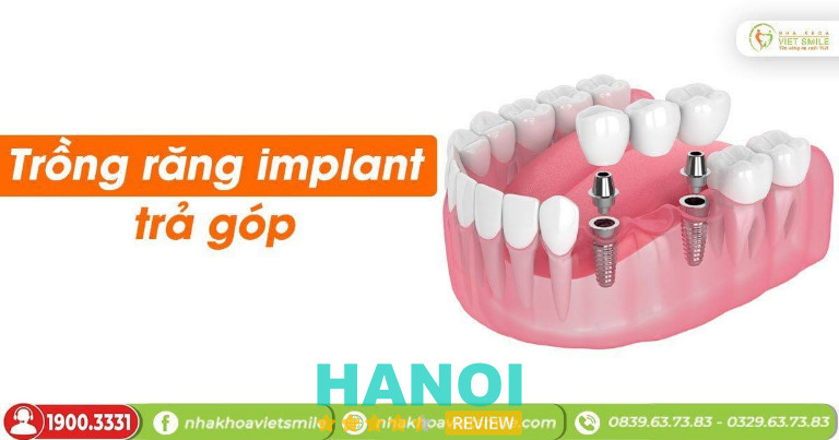 Địa chỉ trồng răng Implant tại Hà Nội 