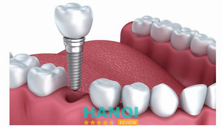 Địa chỉ trồng răng Implant tại Hà Nội 