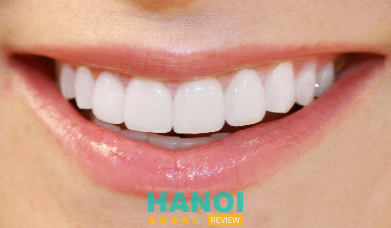 Nha khoa Smile One là địa chỉ bọc răng sứ thẩm mỹ ở Hà Nội chất lượng