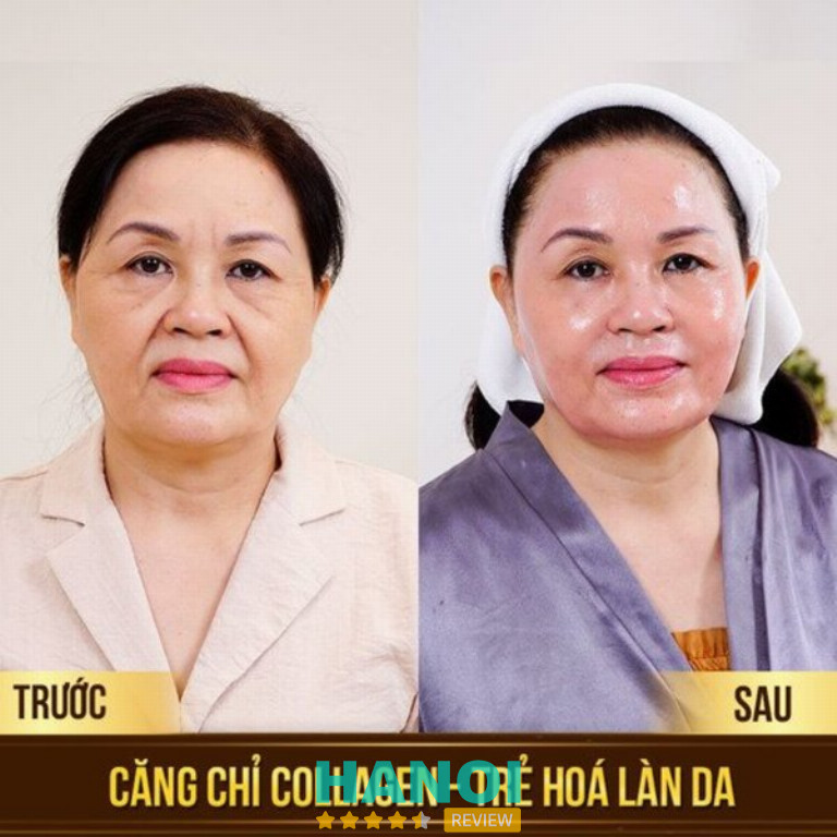 Thẩm mỹ viện Maya Clinic căng chỉ trẻ hóa da mặt tại Hà nội