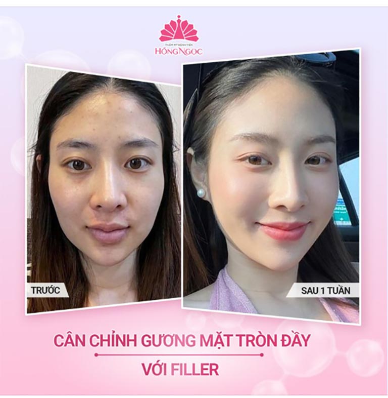 Địa chỉ tiêm Filler tại Hà Nội 