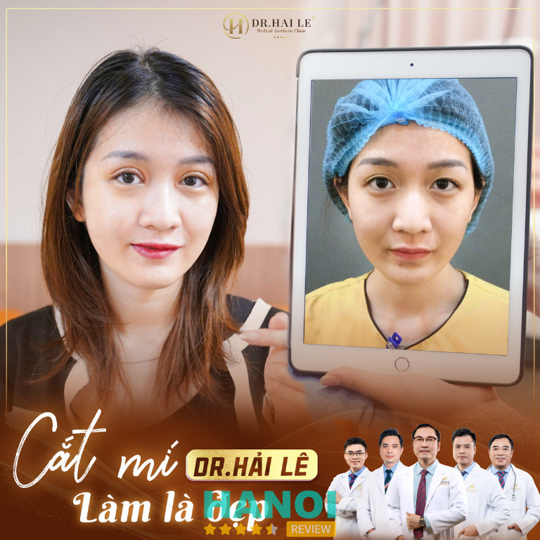 Dr Hải Lê địa chỉ cắt mí mắt đẹp Hà Nội