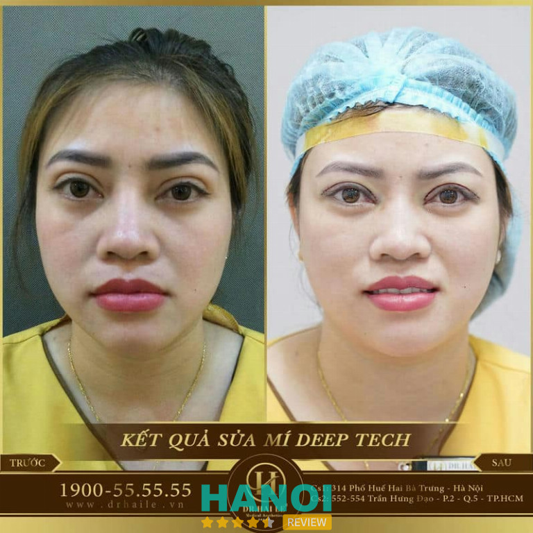 Dr Hải Lê cắt mí mắt đẹp Hà Nội